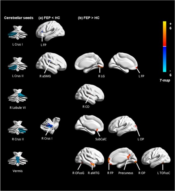 Altered Intrinsic Cerebellar Cerebral Functional Connectivity Is Related To Negative Symptoms In 2221