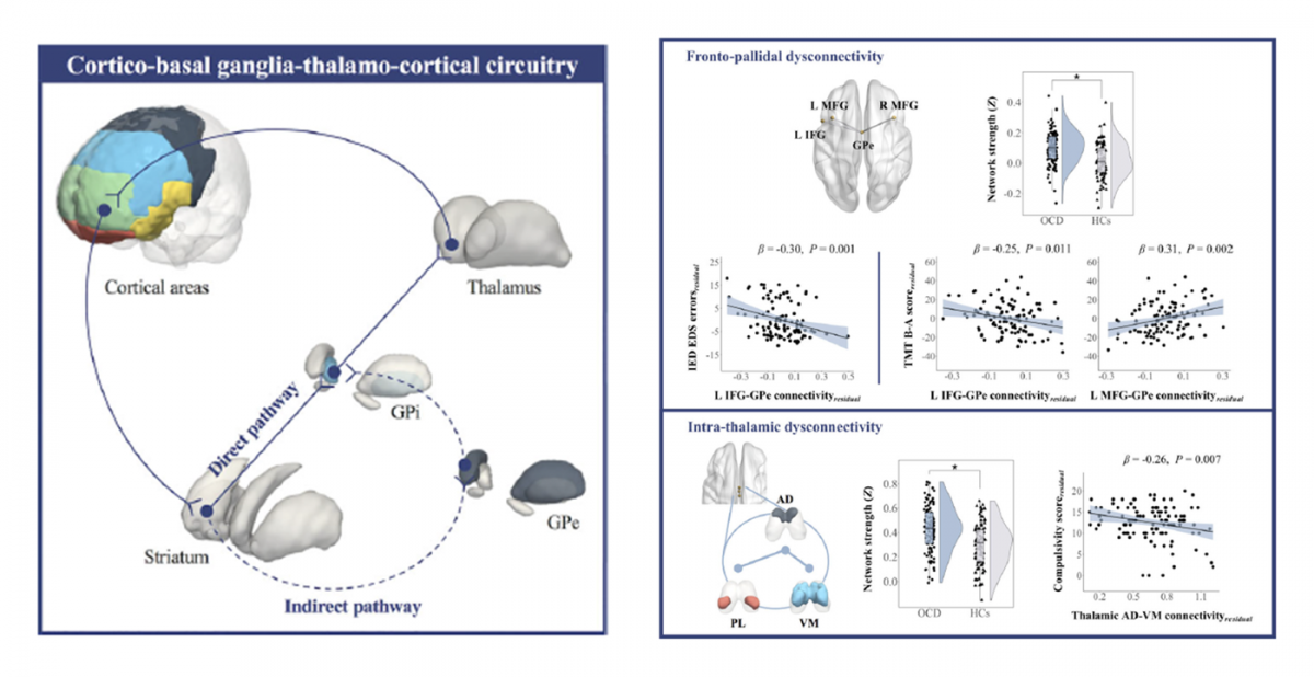 Fronto-pallidal and intra-thalamic dysconnectivity in OCD