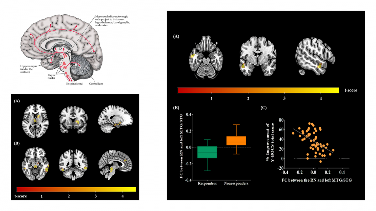 Raphe nucleus functional connectivity and SSRI response in OCD